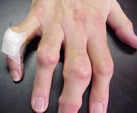 հոդերի դեֆորմացիայով մատները ցավ են պատճառում