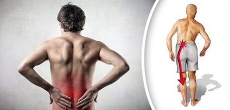 Pain ավի համախտանիշ Lumbar Osteochondrosis- ի հետ ճառագայթում է ոտքերը